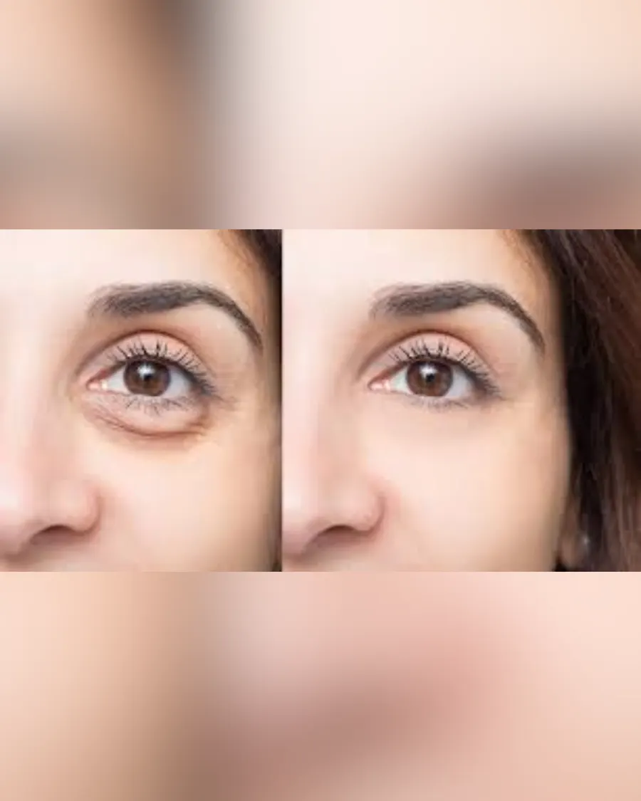 Under-Eye Correction at Cinch Clinics